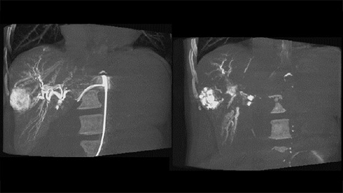 Im&aacute;genes 3D despu&eacute;s de la embolizaci&oacute;n con CBCT