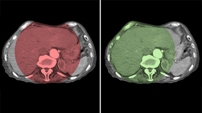 Cobertura del h&iacute;gado completo con CBCT Open