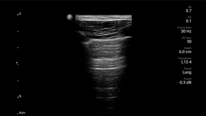 &Uacute;ltimo video del pulm&oacute;n en miniatura