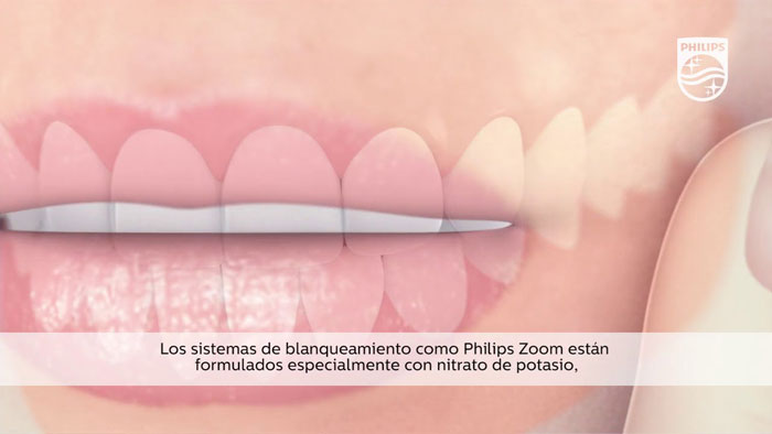 V&iacute;deo de lo qu&eacute; causa la sensibilidad en los dientes