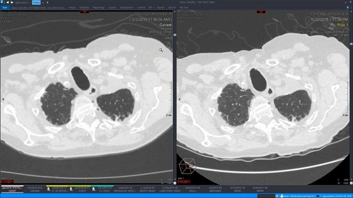 Demostraci&oacute;n del espacio de trabajo de radiolog&iacute;a &uacute;nico de Philips con visualizaci&oacute;n avanzada